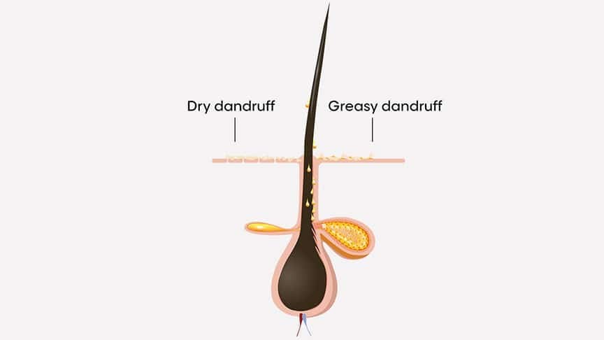 dry-scalp-vs-dandruff 2