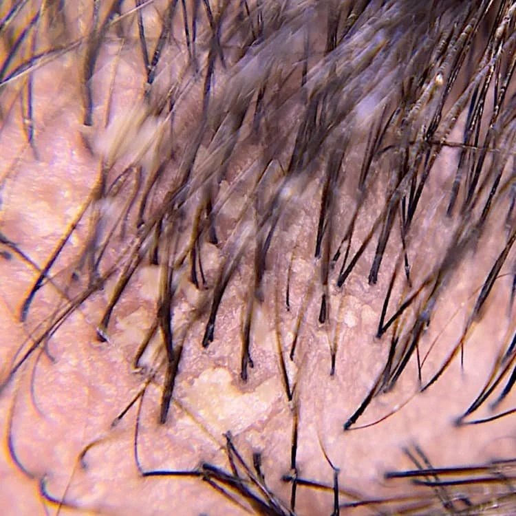 A close-up image of an oily scalp.