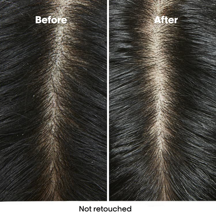 Before and after of a woman’s scalp, visibly healthier and dandruff-free after following an anti-dandruff care routine